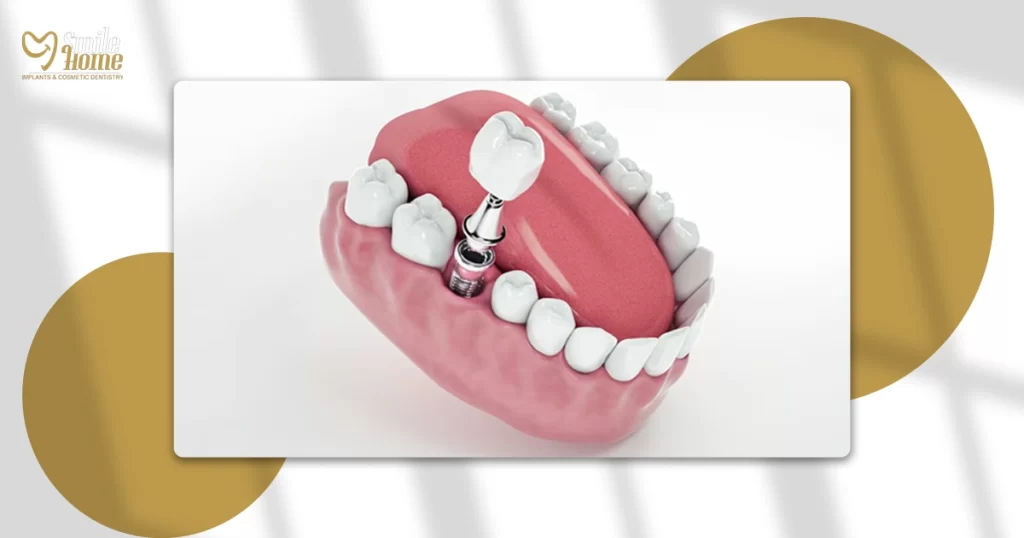 سعر حشو الضرس العادي