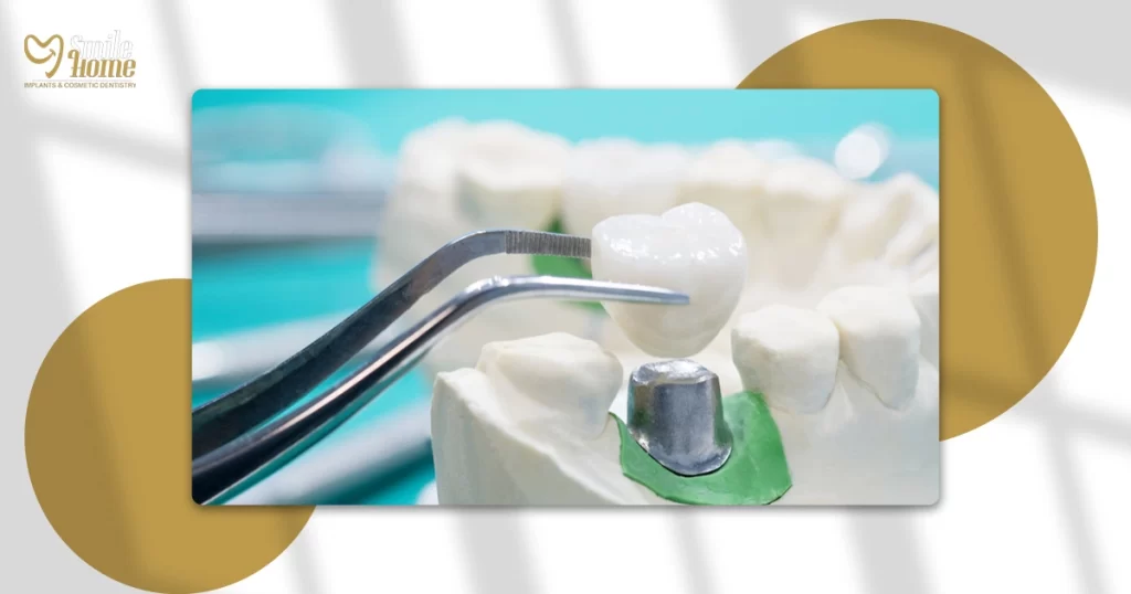 انواع الكراون للاسنان