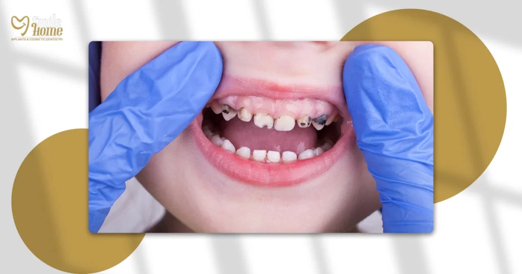 اسباب تسوس الاسنان عند الاطفال