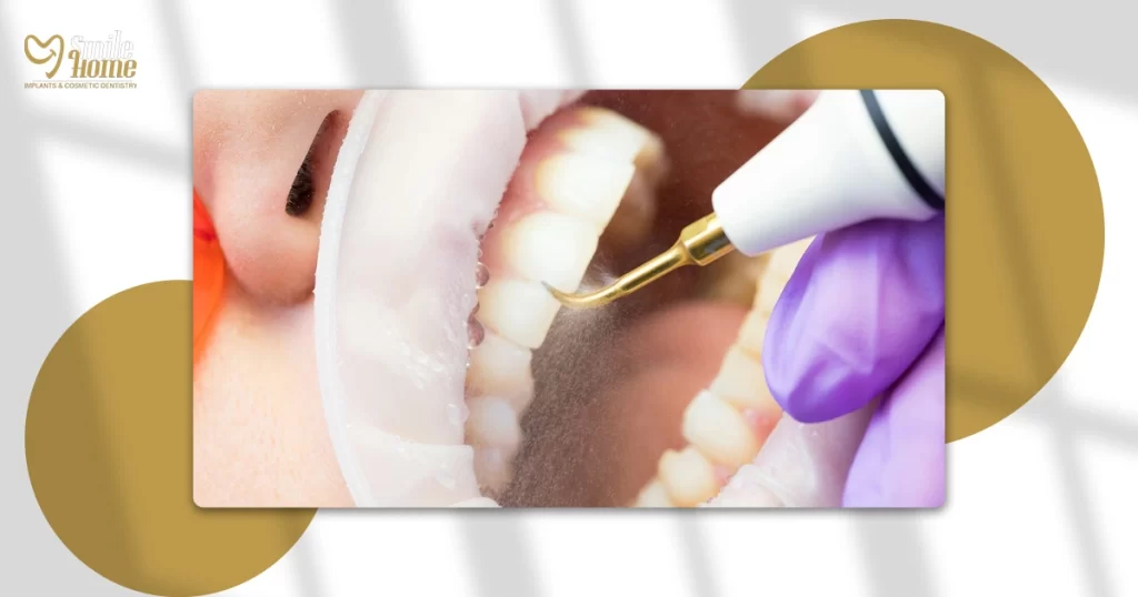 سعر ازالة الجير من الاسنان