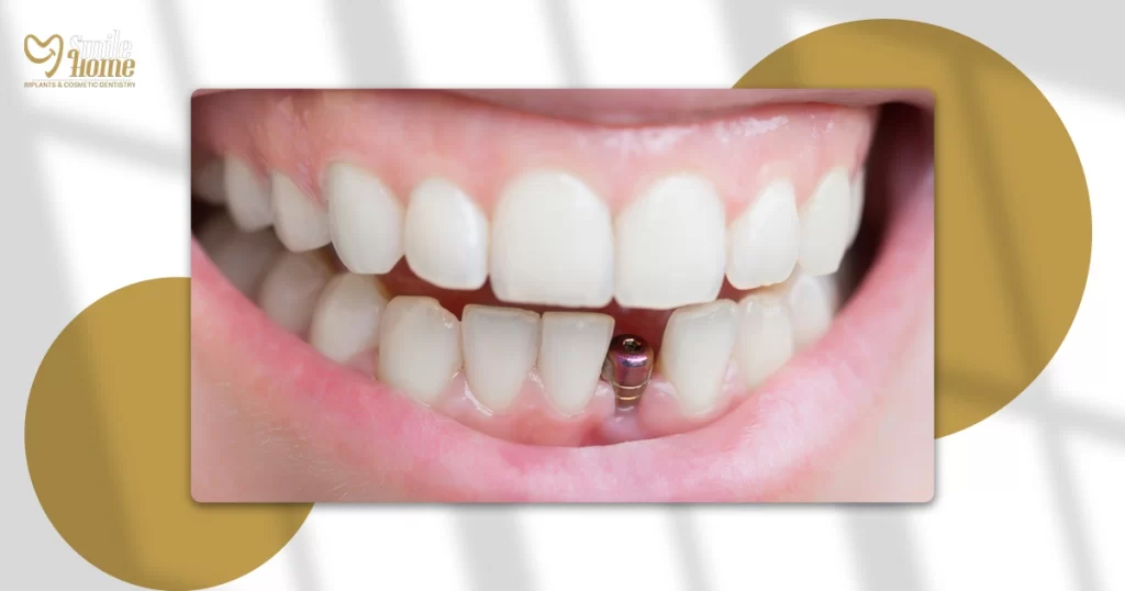 تكلفة زراعة الضرس الواحد في مصر