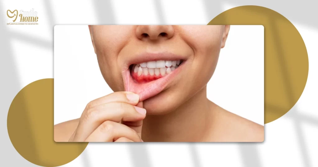 تنظيف اللثة