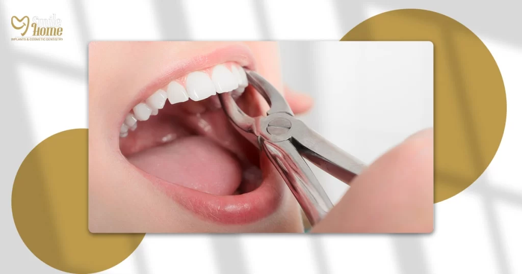 سعر خلع ضرس العقل بدون جراحة