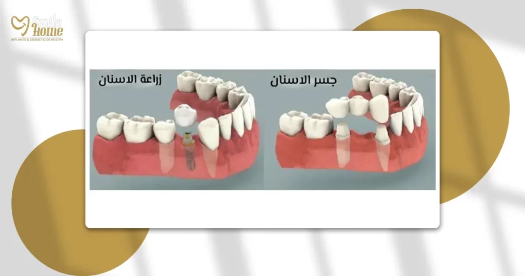 الفرق بين زراعة الاسنان والجسر