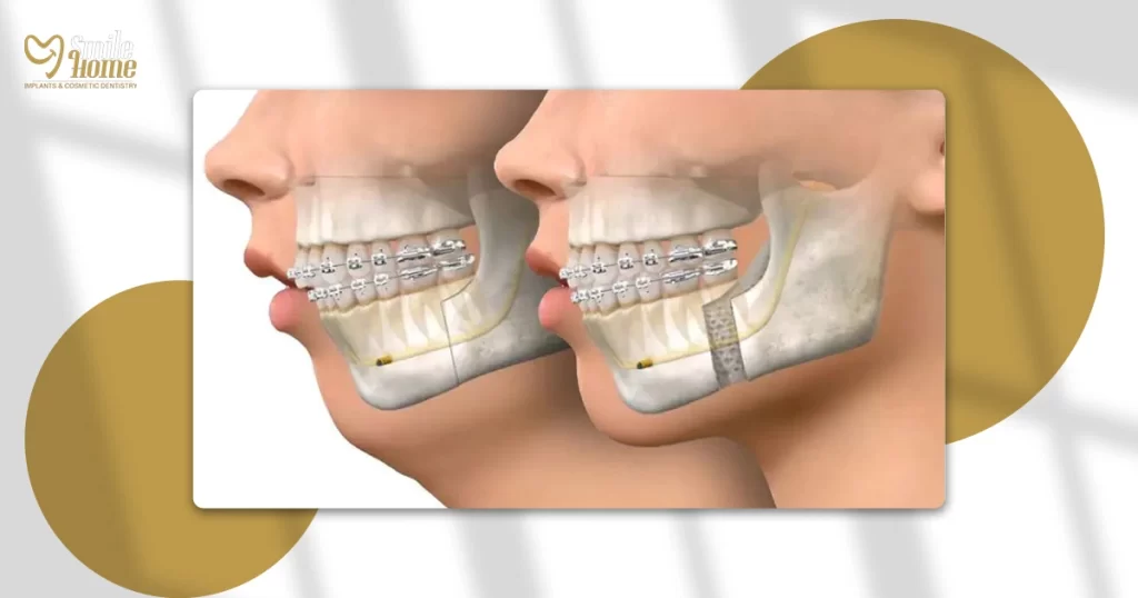 الفرق بين بروز الفك وبروز الأسنان