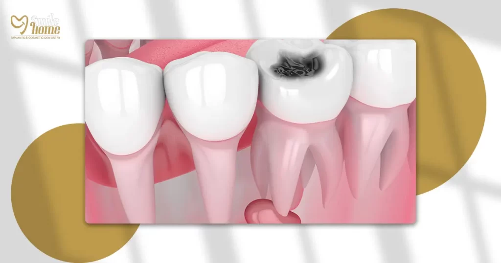 علاج التهاب الضرس بعد الحشو