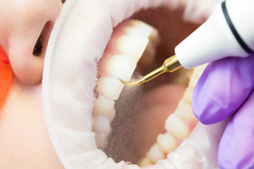 كيفية التخلص من اصفرار الأسنان والجير