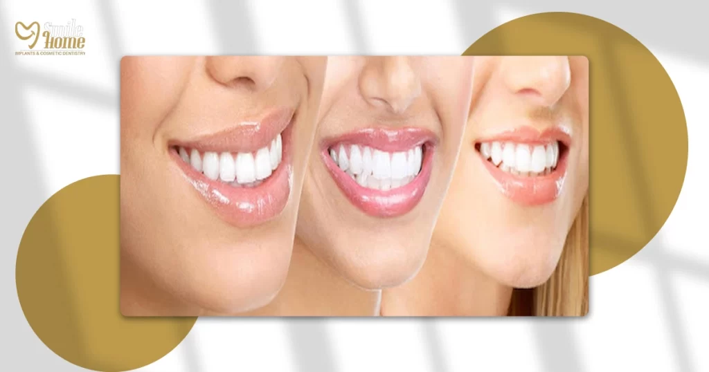 أنواع تجميل الأسنان